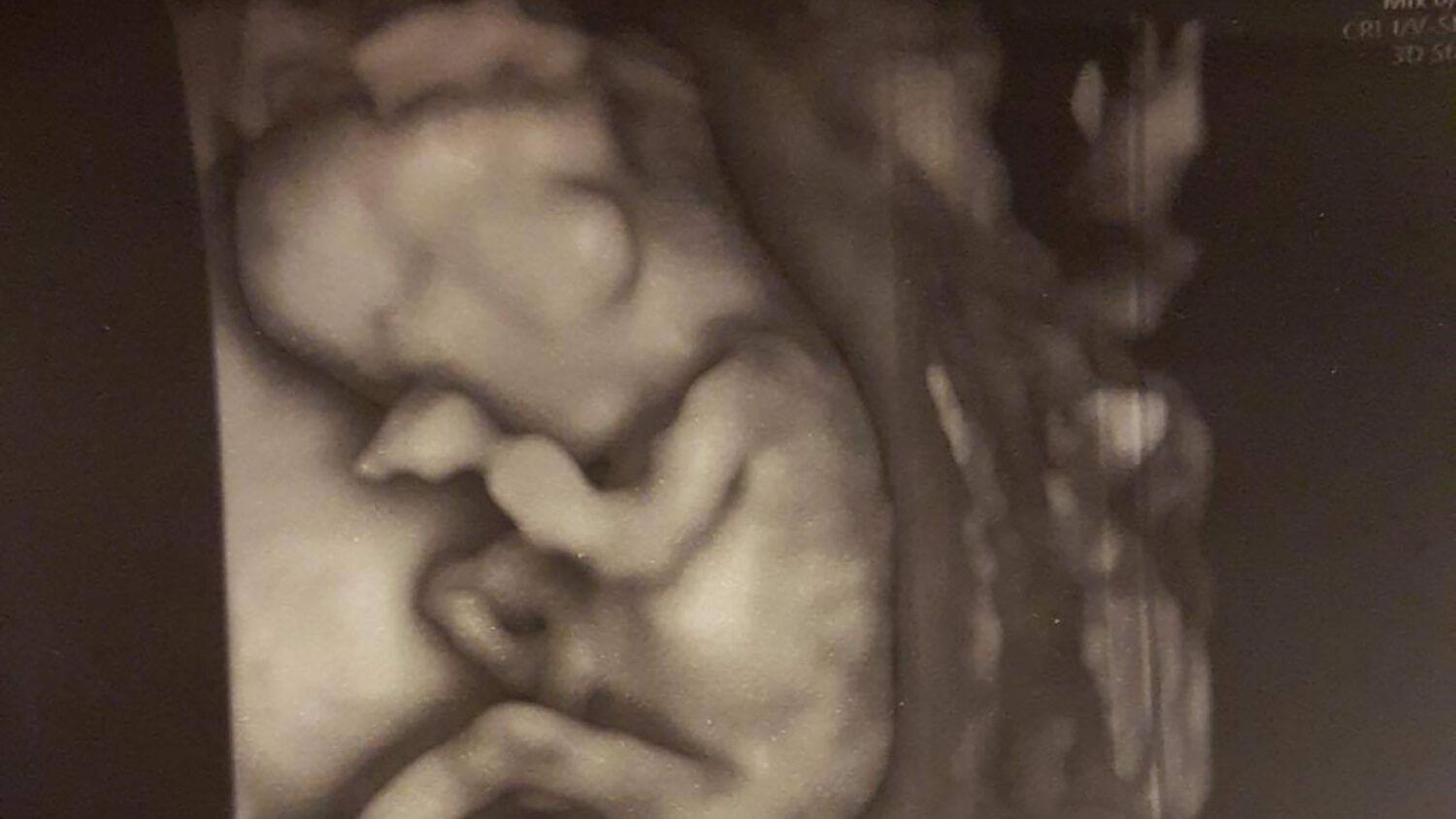 Soňa o svojom dieťatku s vážnou diagnózou: Kto iný by ho mal milovať, ak nie mama?